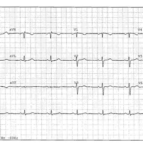 minor inferior repolarization disturbance consider ischemia